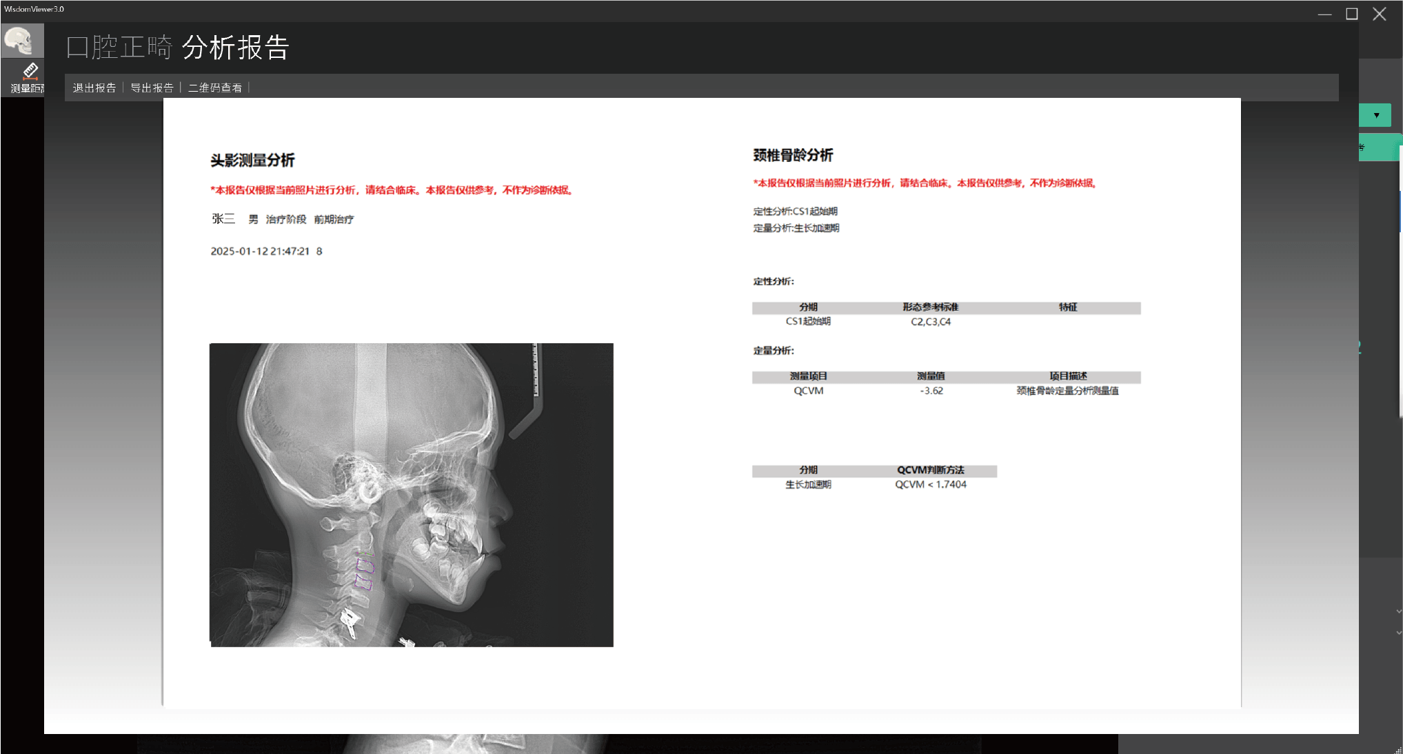 正畸软件骨龄分析报告